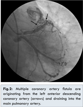 Coronary-to-Pulmonary Artery Fistula and Concomitant Acute Coronary